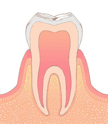 初期虫歯（CO）