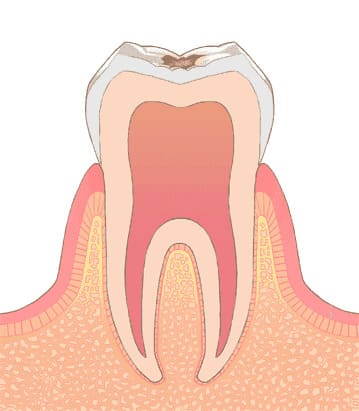 歯の表面虫歯（C1）