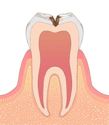 象牙質虫歯（C2）