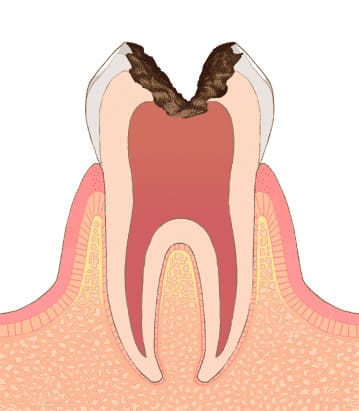 歯髄炎（C3）