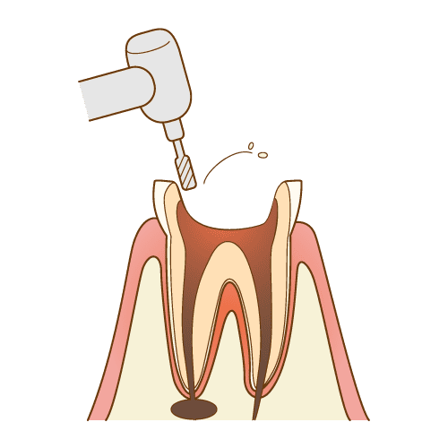 麻酔と歯髄露出