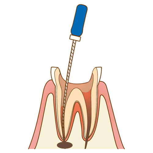 歯髄の除去