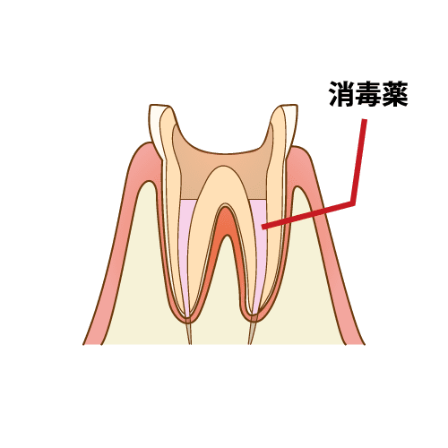 薬の投与と一時閉鎖